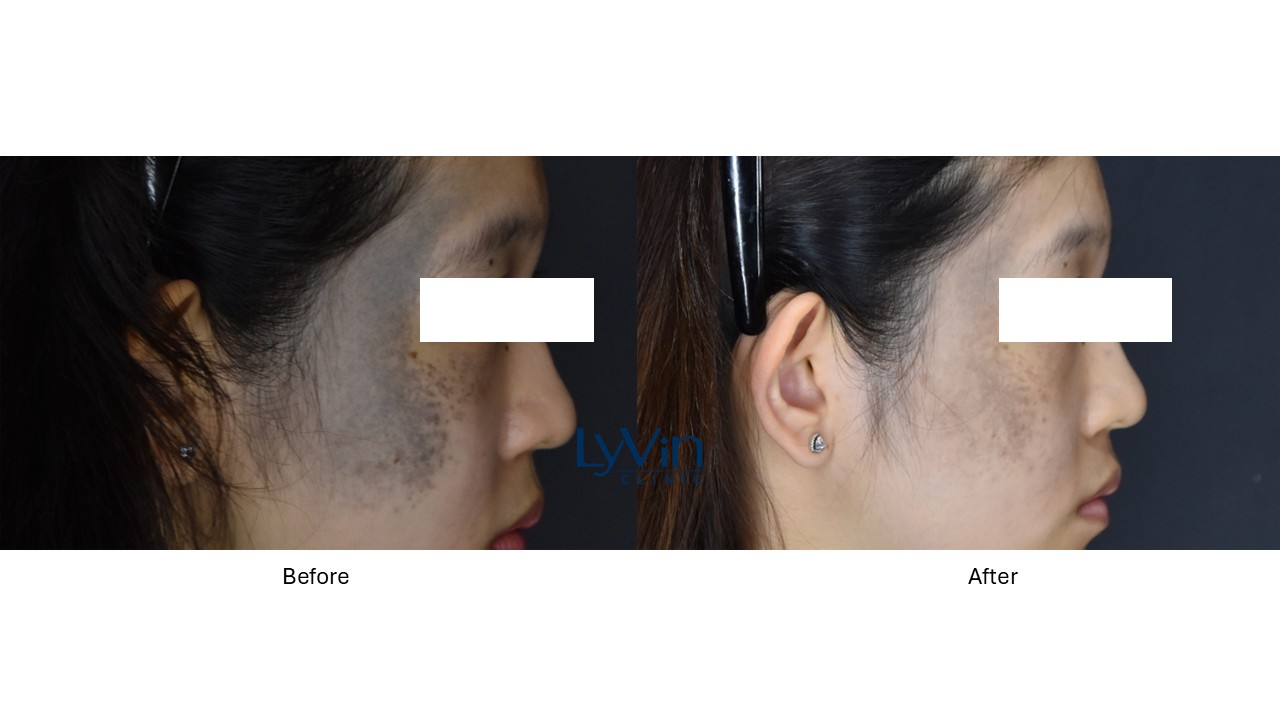 Before and after results of PicoSure Laser
